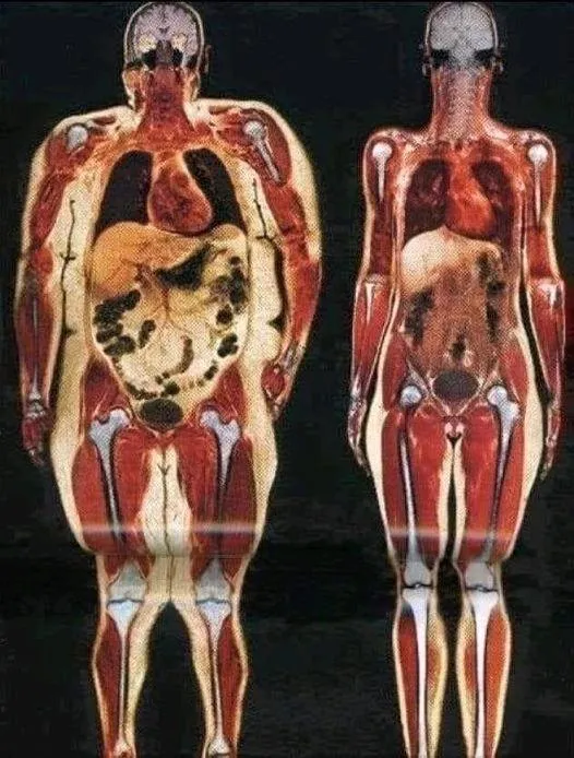 difference between fat person and normal person in x ray